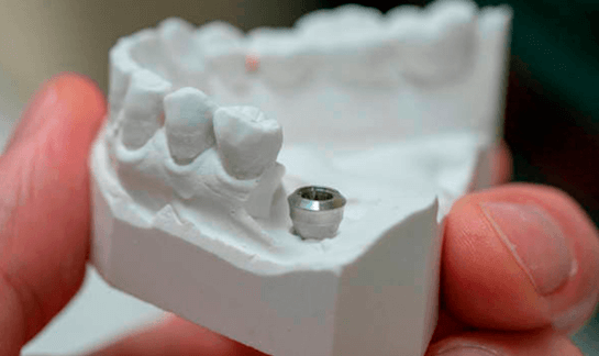 Импланты зубов в СПб